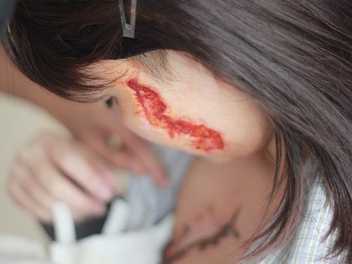 Cô gái bị xăm "quái vật" lên mặt: Vết xăm biến thành sẹo lõm ảnh 2